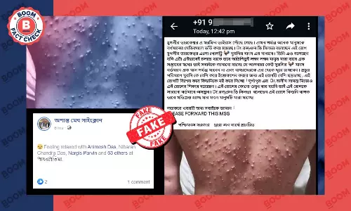 চিকেন পক্সের পুরনো ছবি মরফিন ভাইরাসের প্রকোপ বলে ফের ছড়াল চিকেন পক্সের পুরনো ছবি মরফিন ভাইরাসের প্রকোপ বলে ফের ছড়াল